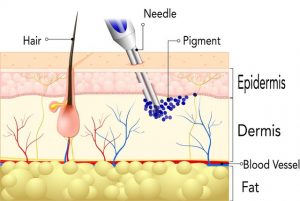 Illustration of Procedure